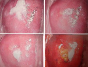 Chữa viêm âm đạo do nấm candida