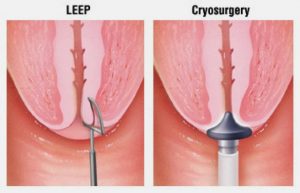 Chữa bệnh phụ khoa bằng phương pháp cắt dao điện LEEP