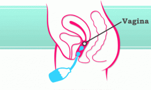 Nguyên nhân gây viêm âm đạo có thể do thụt rửa âm đạo thường xuyên