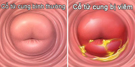 Viêm cổ tử cung là tình trạng cổ tử cung bị viêm nhiễm