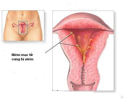 Bệnh viêm nội mạc tử cung cũng khiến khí hư có màu xanh