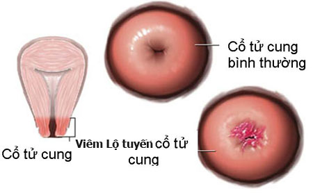 nguyên nhân gây bệnh huyết trắng có thể do bệnh viêm lộ tuyến cổ tử cung gây ra