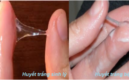 Nhận biết huyết trắng sinh lý và huyết trắng bệnh lý