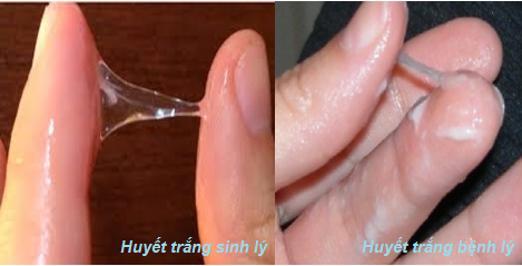 nguyên nhân gây bệnh huyết trắng