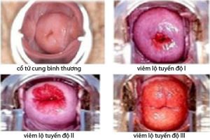 hinh-anh-viem-lo-tuyen-co-tu-cung-theo-3-cap-do