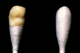 Khí hư màu vàng ra nhiều, kèm các bất thường khác: Hãy cẩn trọng