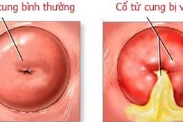 Viêm nhiễm ở cổ tử cung
