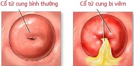 Viêm nhiễm ở cổ tử cung