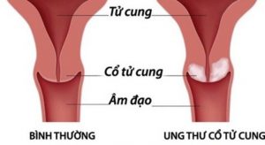 Cổ tử cung nếu không chữa trị sẽ dẫn tới ung thư cổ tử cung