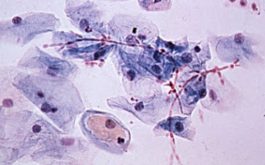 Nấm candida là "thủ phạm" số 1 gây bệnh nấm âm đạoNấm candida là "thủ phạm" số 1 gây bệnh nấm âm đạo