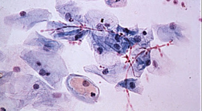 Nấm candida là "thủ phạm" số 1 gây bệnh nấm âm đạoNấm candida là "thủ phạm" số 1 gây bệnh nấm âm đạo