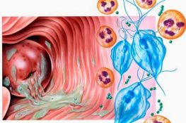 Viêm âm đạo do Trùng roi Trichomonas thường khiến huyết trắng có màu vàng, loãng và có bọt