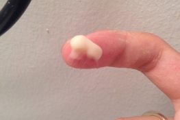 Huyết trắng vón cục như bã đậu, kèm theo ngứa ngáy là triệu chứng bệnh viêm âm đạo do nấm