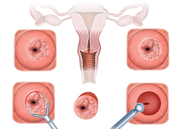Nấm cổ tử cung đe dọa sức khỏe sinh sản của phụ nữ