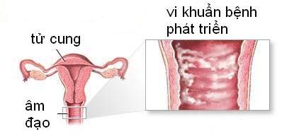 Viêm âm đạo gây ra tình trạng huyết trắng lẫn máu