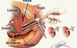 Cách dùng mỏ vịt khám phụ khoa
