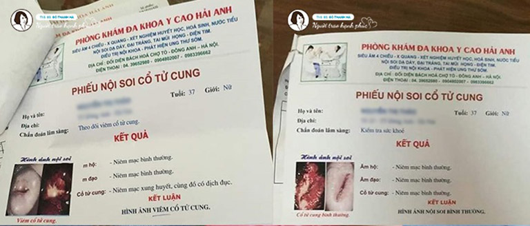 Viêm lộ tuyến cổ tử cung được cải thiện sau khi sử dụng bài thuốc