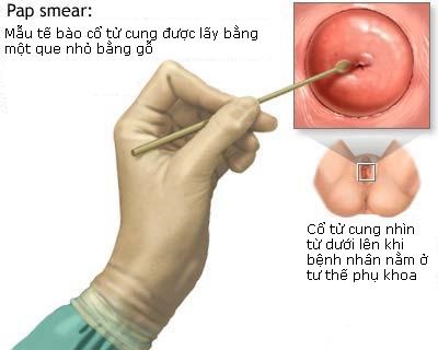 Xét nghiệm Pap smear giúp phát hiện sớm ung thư cổ tử cung