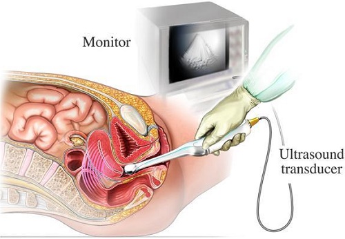 Siêu âm đầu dò âm đạo mang nhiều lợi ích