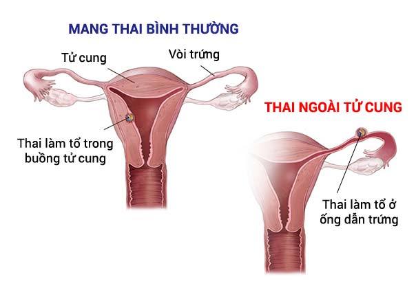 Mang thai ngoài tử cung báo hiệu bằng việc xuất huyết âm đạo