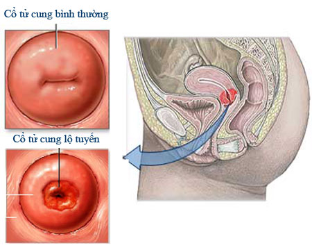 Viêm lộ tuyến cổ tử cung - Bệnh phụ khoa thường gặp