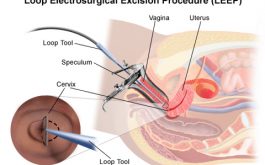 Kỹ thuật điều trị viêm lộ tuyến cổ tử cung bằng dao Leep