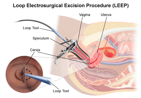 Chữa viêm lộ tuyến cổ tử cung bằng dao Leep là sao, có tốt không?