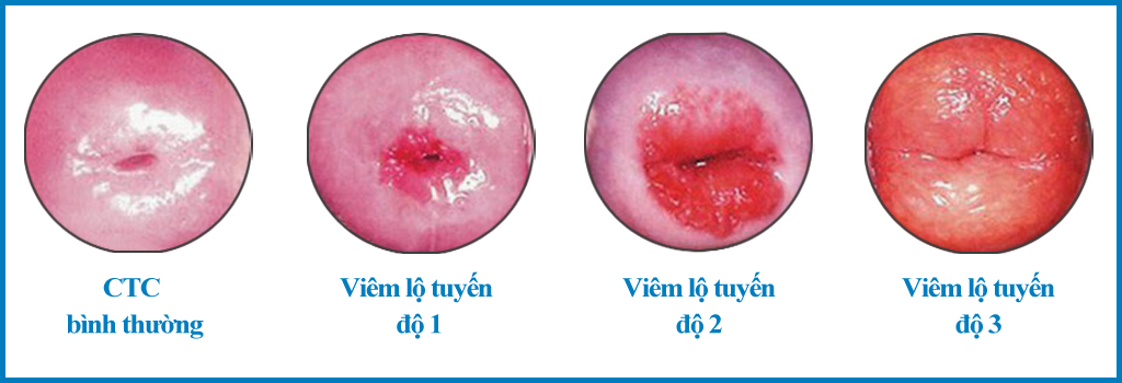 Đốt điện cổ tử cung được chỉ định cho trường hợp viêm lộ tuyến nặng