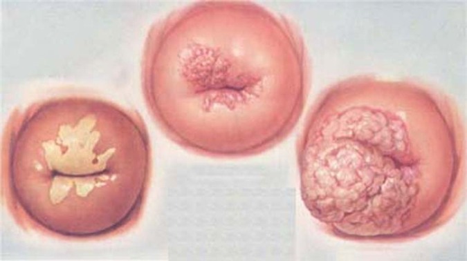 Hình ảnh viêm lộ tuyến cổ tử cung