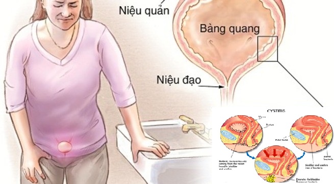 Bị viêm niệu đạo có nguy hiểm không bác sĩ?