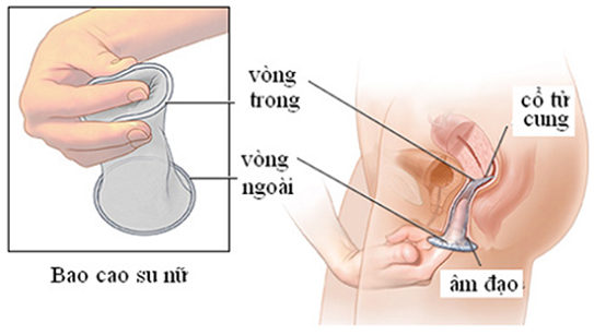 Đặt thuốc phụ khoa đúng kỹ thuật sẽ không khiến màng trinh tổn hại