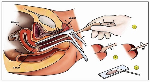 khám phụ khoa khi mang thai bằng mỏ vịt