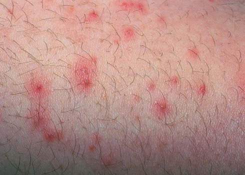 Viêm nang lông - "thủ phạm" gây nổi mẩn đỏ và ngứa sau cạo lông vùng kín