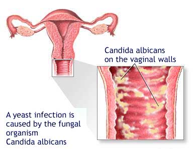 nấm candida