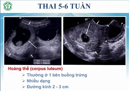 có phải siêu âm đầu dò phát hiện thai sớm không