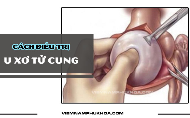 cách điều trị u xơ tử cung