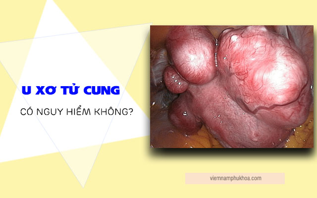 u xơ tử cung có nguy hiểm không