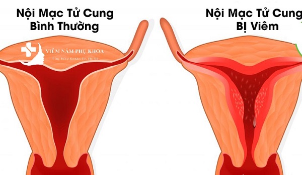 Dấu hiệu viêm tử cung