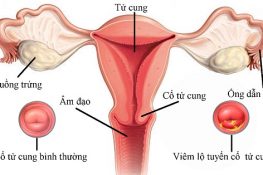 Vì sao nên chữa viêm tử cung tại Đỗ Minh Đường