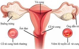 Vì sao nên chữa viêm tử cung tại Đỗ Minh Đường