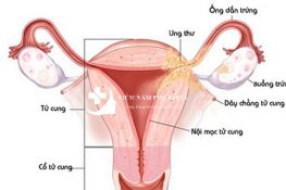 Nguyên nhân viêm tử cung