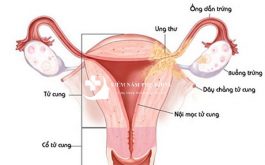 Nguyên nhân viêm tử cung