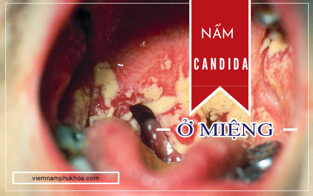 nấm Candida ở miệng