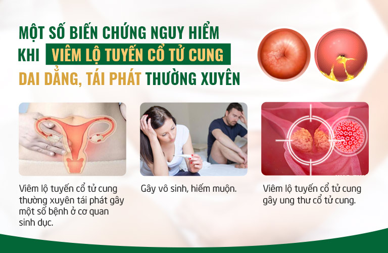 Viêm lộ tuyến cổ tử cung là bệnh lý Phụ khoa gây ra nhiều biến chứng nguy hiểm