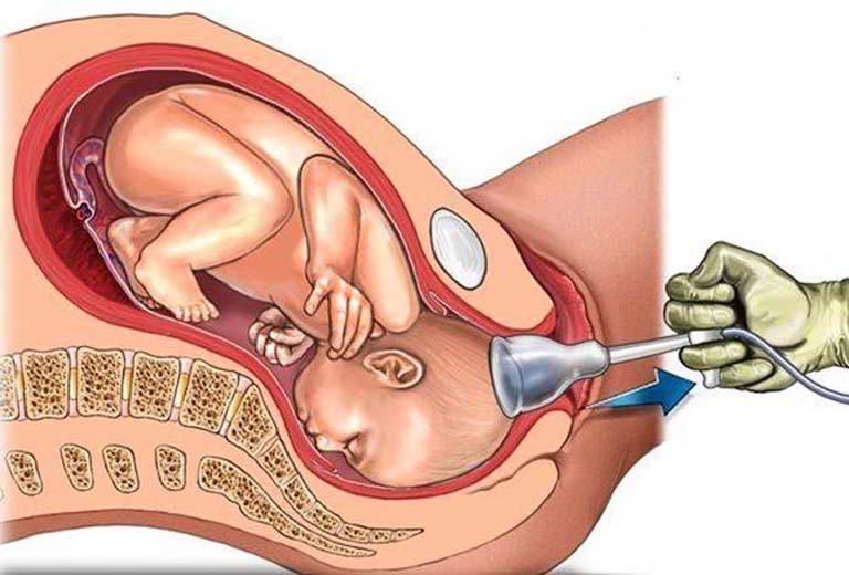 Không lạm dụng nạo phá thai để ngăn ngừa viêm lộ tuyến cổ tử cung