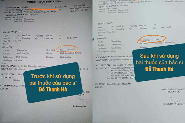 Kết quả điều trị của bệnh nhân với bài thuốc Diệp Phụ Khang chữa viêm lộ tuyến cổ tử cung