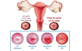 Viêm lộ tuyến cổ tử cung có 3 cấp độ khác nhau tuỳ vào sự tiến triển của bệnh