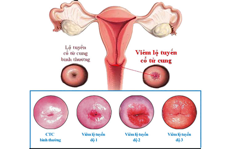 Viêm lộ tuyến cổ tử cung có 3 cấp độ khác nhau tuỳ vào sự tiến triển của bệnh