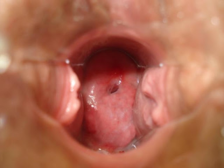 Hình ảnh vùng lộ tuyến cổ tử cung bắt đầu có dấu hiệu viêm
