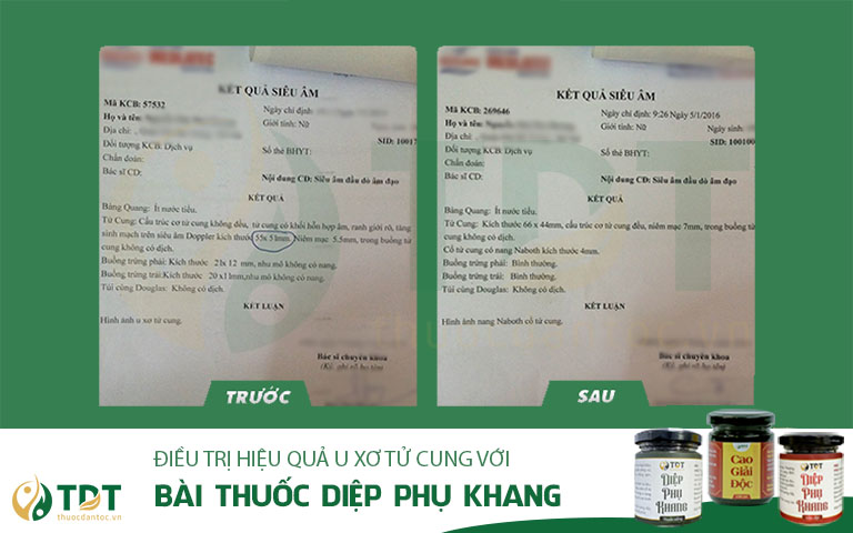 Khối u xơ giảm kích thước sau quá trình điều trị với Diệp Phụ Khang